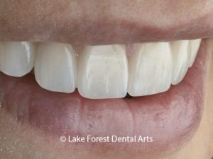 Dental crowns