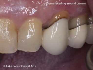 How can i get better creating a crown area? I can barely identify