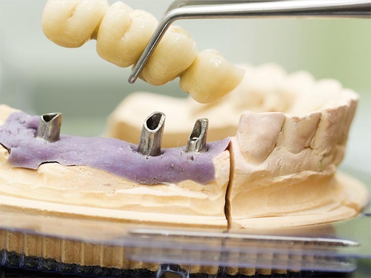 Implant supported bridge