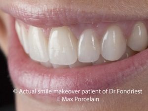 porcelain tooth bridge