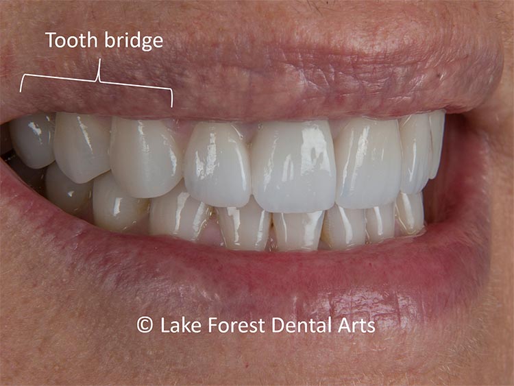 Posterior tooth bridge