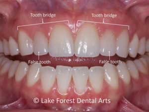 cleaning dental bridges