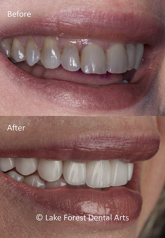 Dark teeth fixed before and after