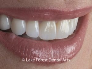 porcelain veneers after treatment