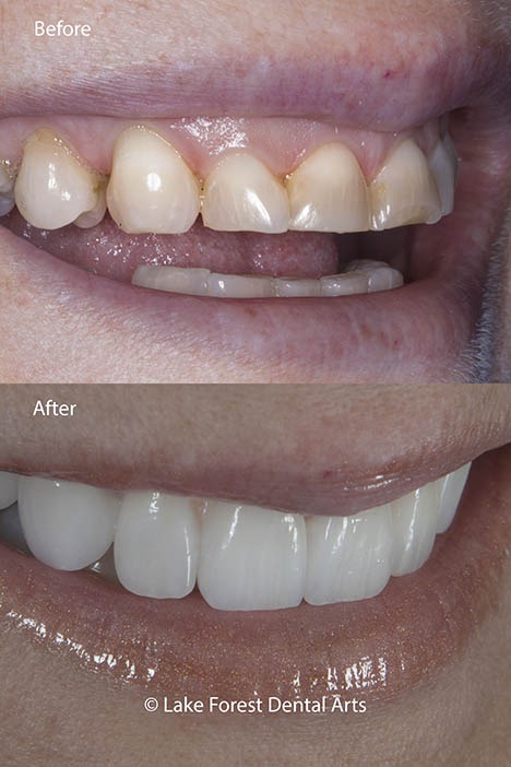 Worn teeth before and after