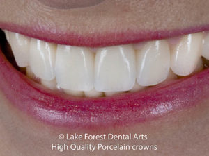 best crowns for teeth