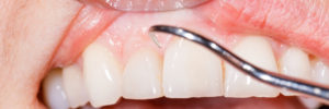 short teeth dental examination