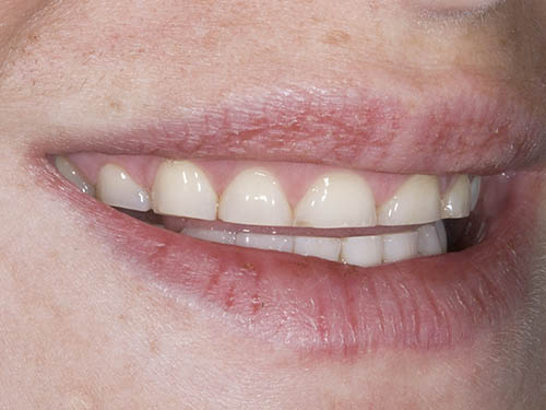 how to fix small teeth in adults