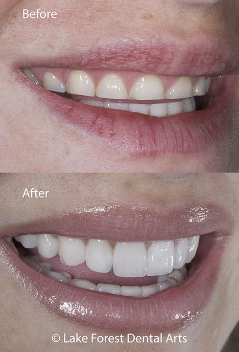 short teeth fixed before and after